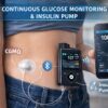 دستگاه‌های تشخیص قند خون پیوسته (CGM) و پمپ انسولین